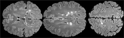 Review of Deep Learning Approaches for the Segmentation of Multiple Sclerosis Lesions on Brain MRI